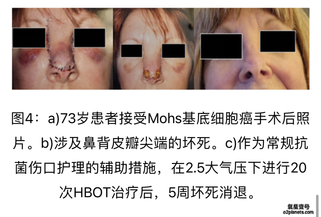 高压氧疗