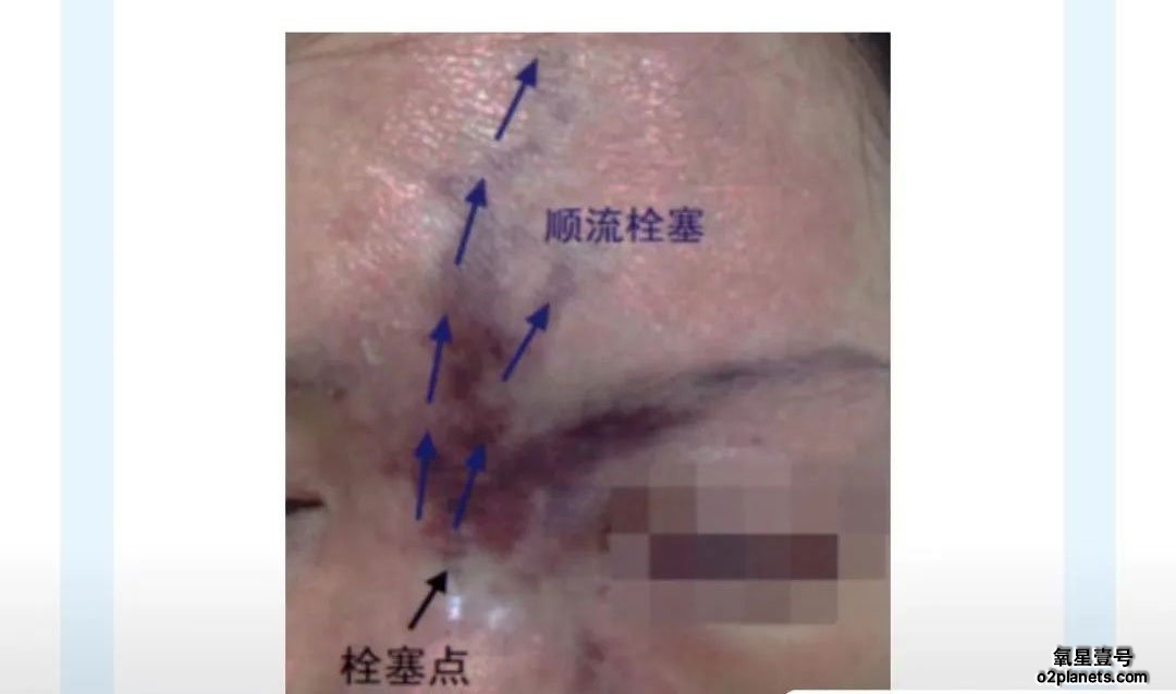 血管栓塞