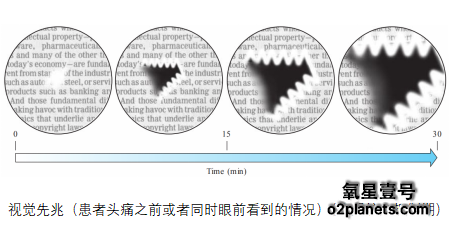 高压氧治疗偏头痛病例报告及文献探讨