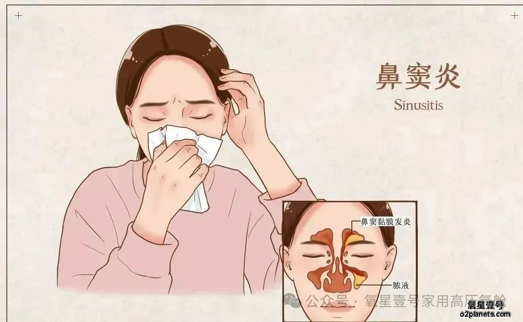 氧护畅呼吸！家用高压氧舱，为鼻炎人群打开舒适新通道