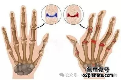 高压氧成为风湿关节炎患者新希望