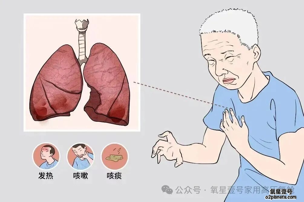 高压氧如何成为肺部疾病的“强力辅助”