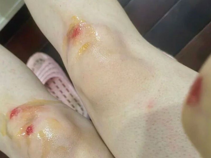 肿胀快速消退!实拍每日膝盖变化，看见高压氧的修复力量