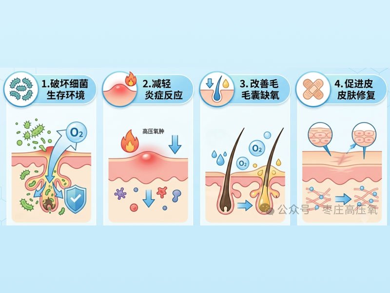 高压氧为什么能治疗寻常痤疮